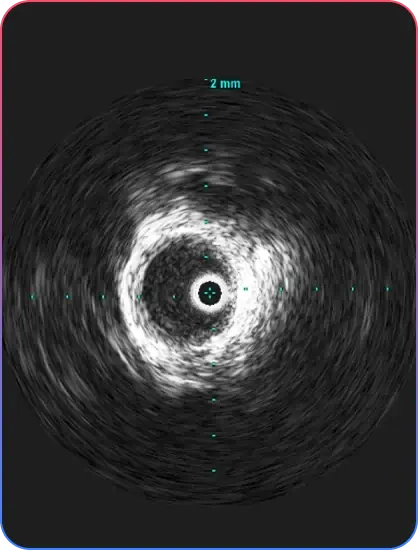 Aorto-Ostial Lesions