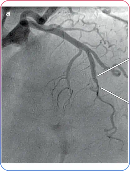 Aorto-Ostial Lesions