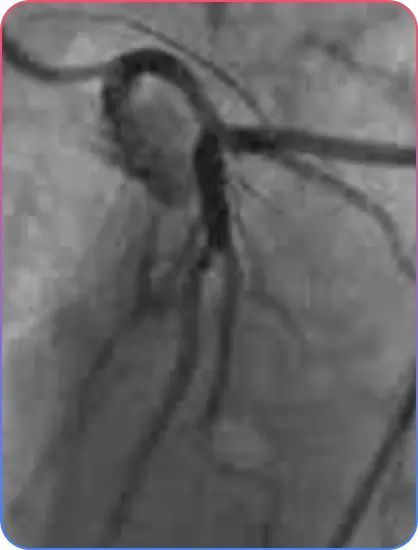 Aorto-Ostial Lesions