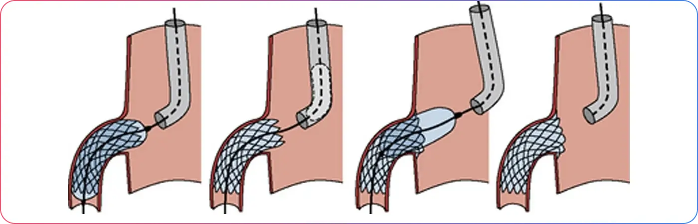 Chronic Total Occlusions