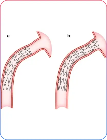 Aorto-Ostial Lesions