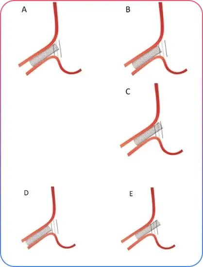 Pre Procedural Imaging