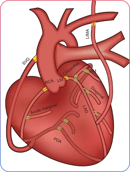 Aorto-Ostial Lesions