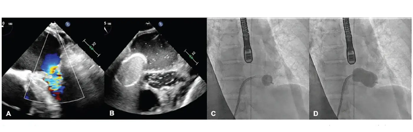 Percutaneous Valve Therapies