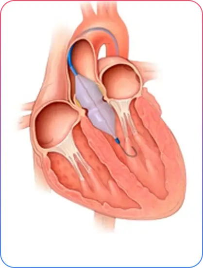 Aorto-Ostial Lesions