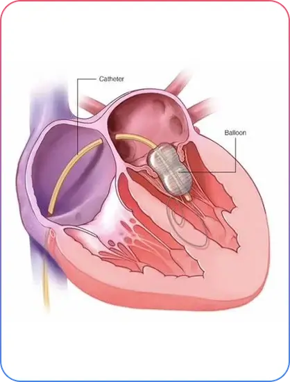 Aorto-Ostial Lesions
