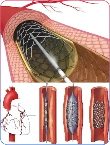 PCI