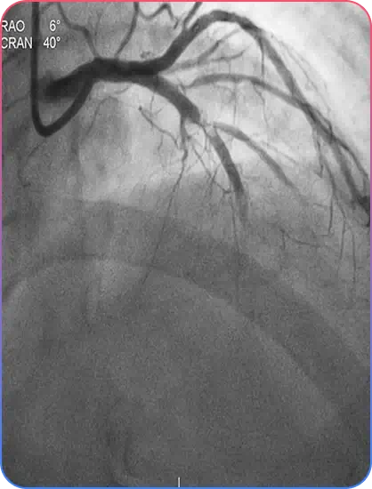Before PCI Procedure