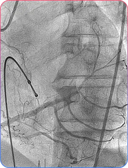 During PCI Procedure