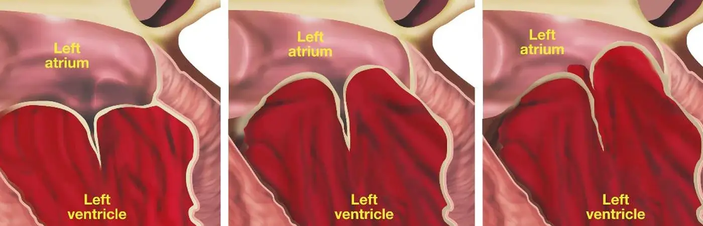 Percutaneous Valve Therapies