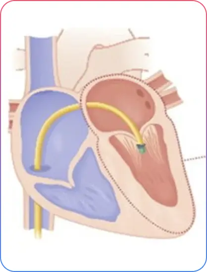 Heart Valve Types Treatment and Conditions