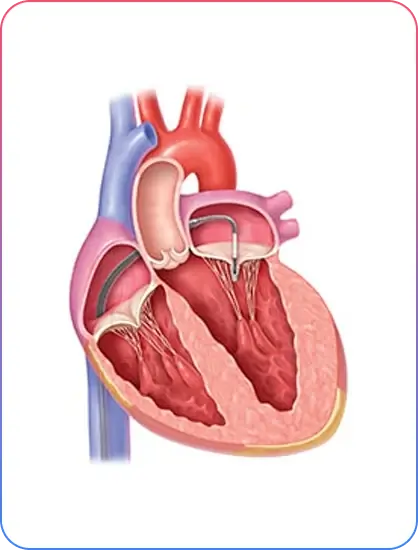 Aorto-Ostial Lesions