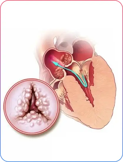 Aorto-Ostial Lesions