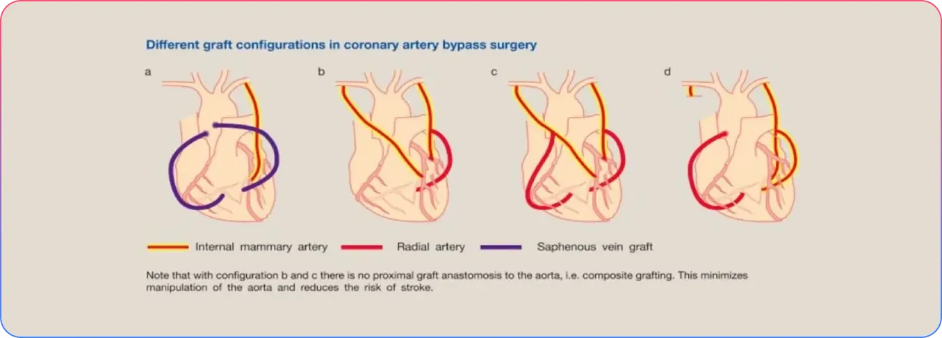 Chronic Total Occlusions
