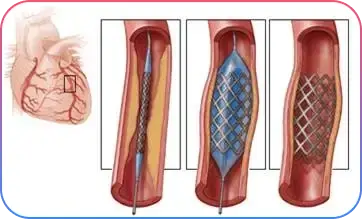 Chronic Total Occlusions