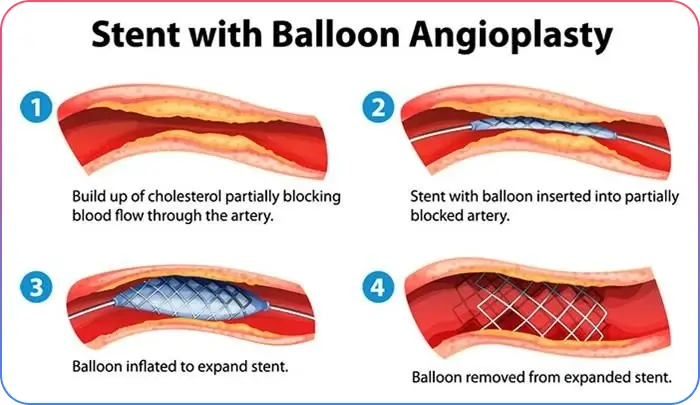 Chronic Total Occlusions