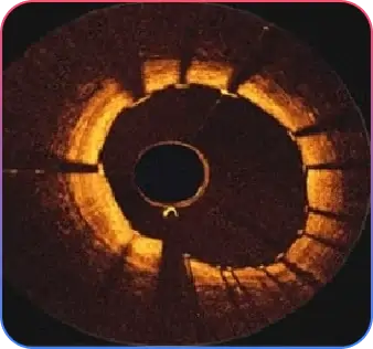 post-cabg-open-heart-surgery-graft-lesions
