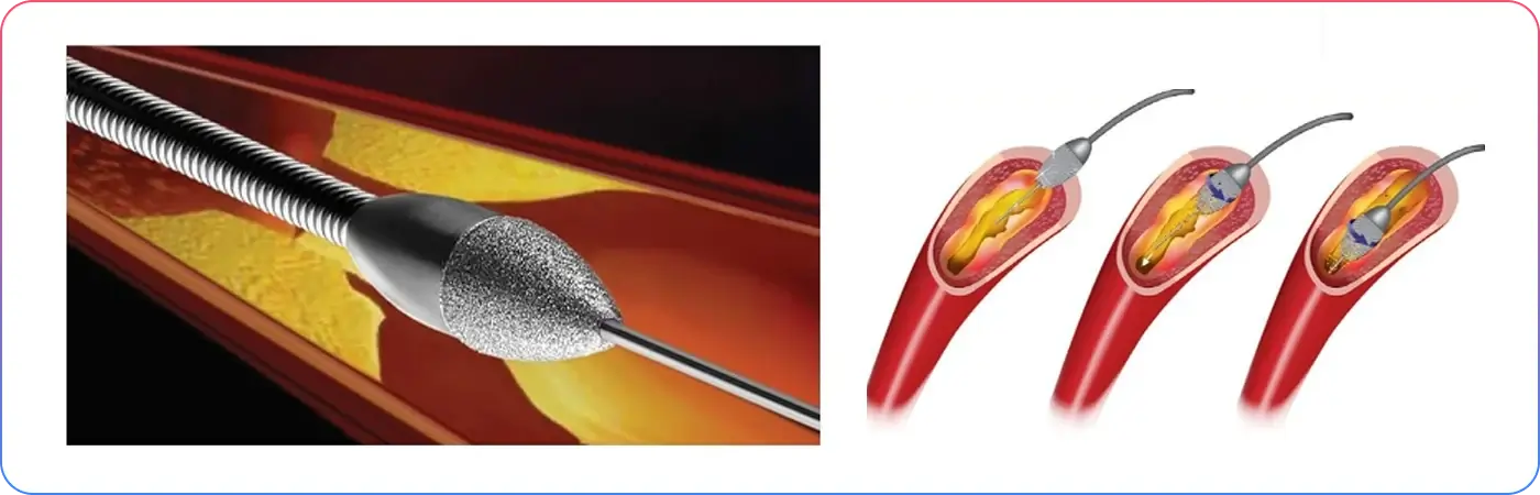 percutaneous-coronary-interventions