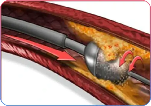 Rotablation Procedure