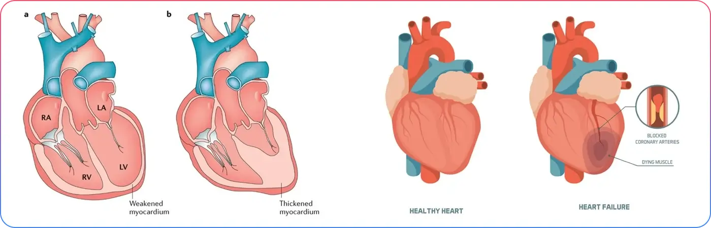 Severe Pumping Dysfunction