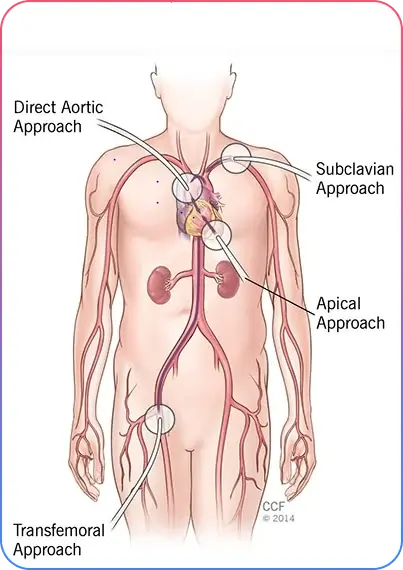 Ventricular Assist Device Surgery