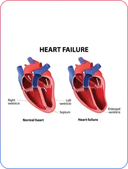 severe-pumping-dysfunction