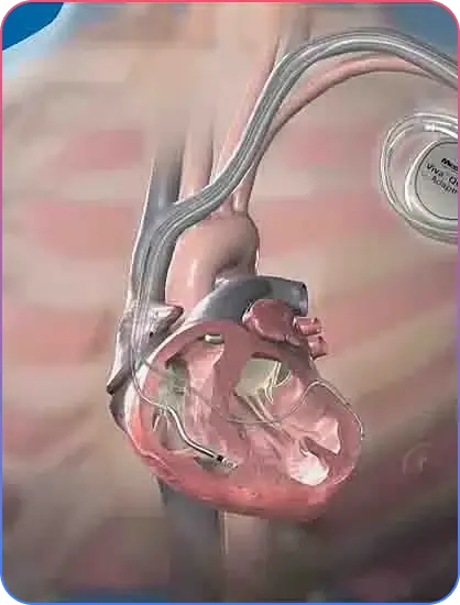 Implantable Cardioverter Defibrillator