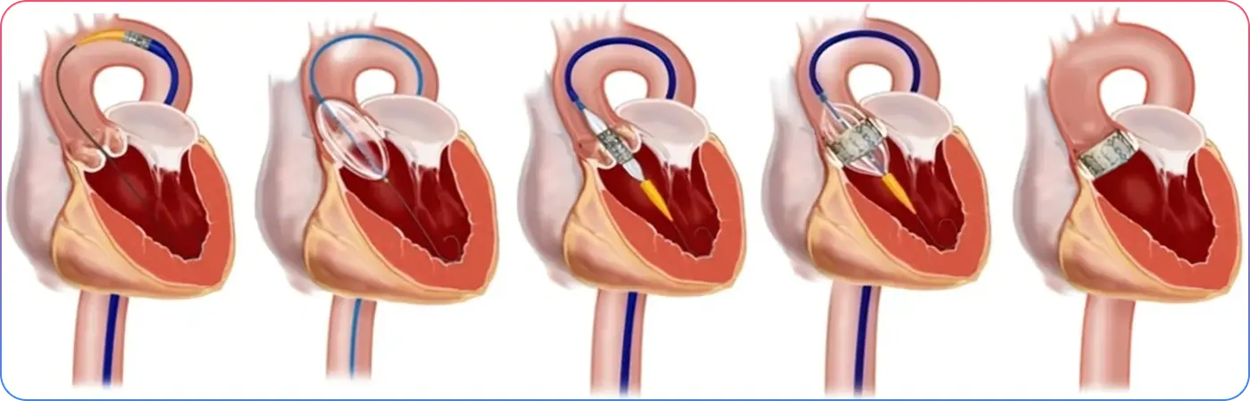 Percutaneous Valve Therapies