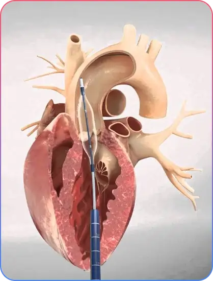 Types of TAVR Approaches