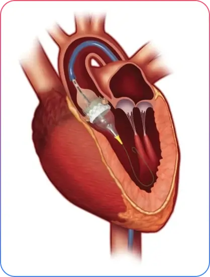 Aorto-Ostial Lesions