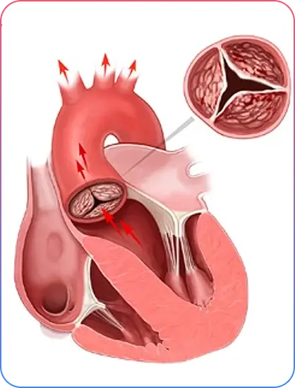 Aorto-Ostial Lesions