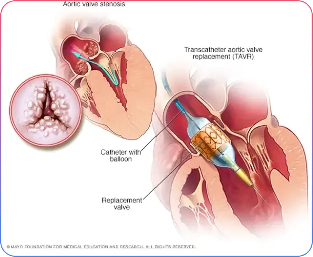 Aorto-Ostial Lesions