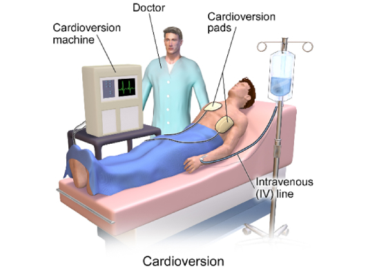 Electric Cardioversion