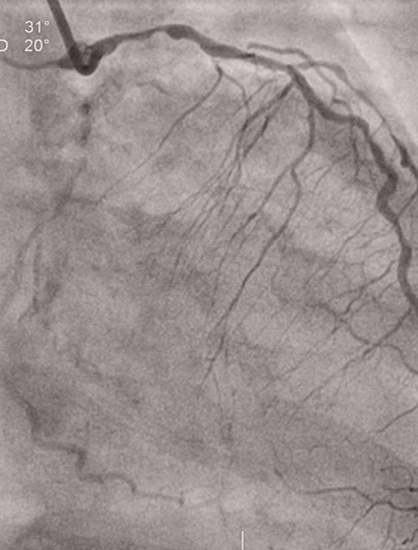 Two-Stent Approach