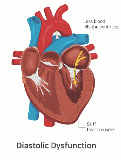 Heart pacemaker