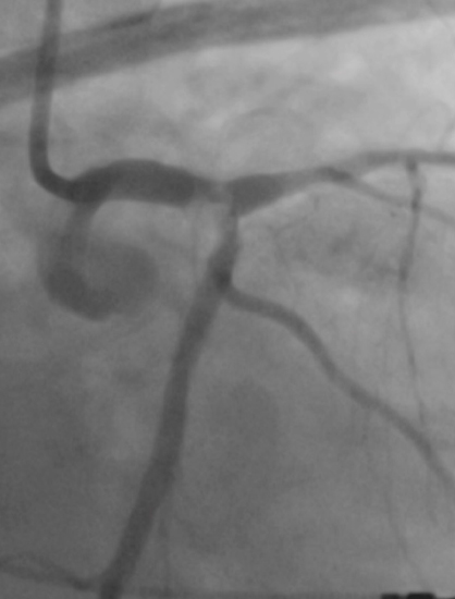 Left main coronary artery