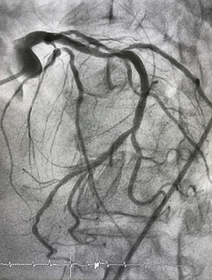 One-Stent Approach