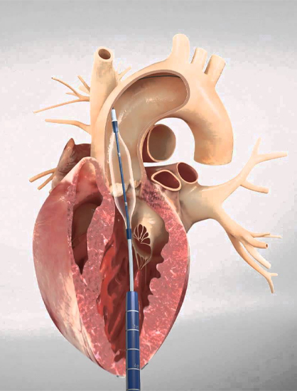 Transcatheter aortic valve replacement
