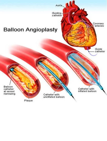 Balloon Angioplasty